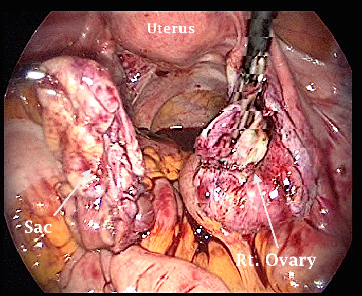 OV_Cyst_sith_sac_removed_marked