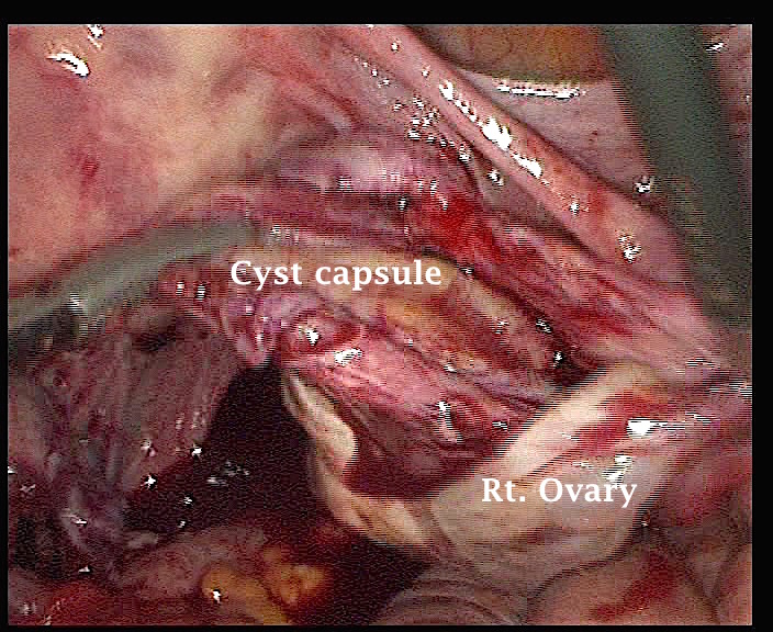 Ov_endometrioma_sac_shelled_copy