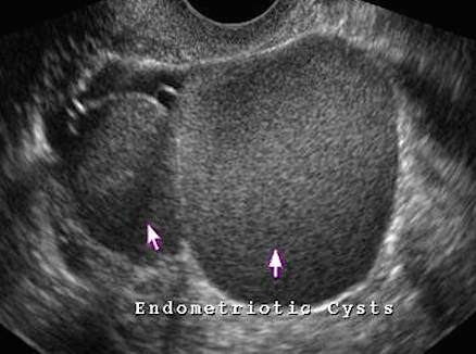 endommetrioma_us