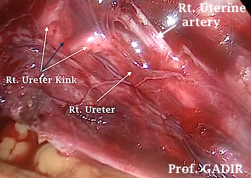 uterer_in_right_side_kinked